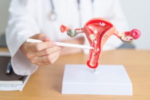 Wie Endometriose-Schmerzen entstehen und gelindert werden können 2